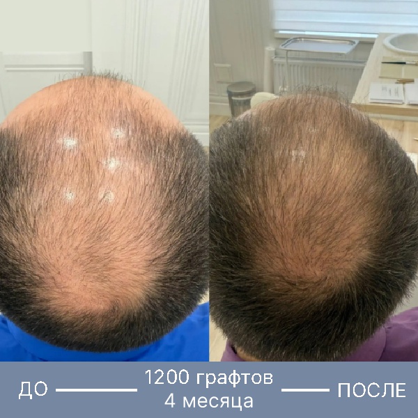 Результат пересадки волос