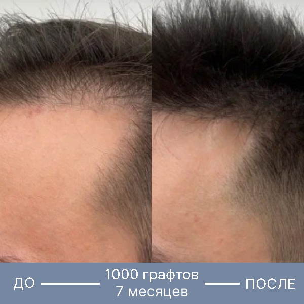 Результат пересадки волос