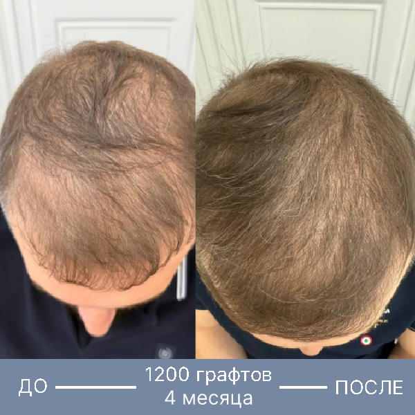Результат пересадки волос