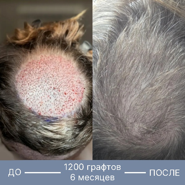 Результат пересадки волос