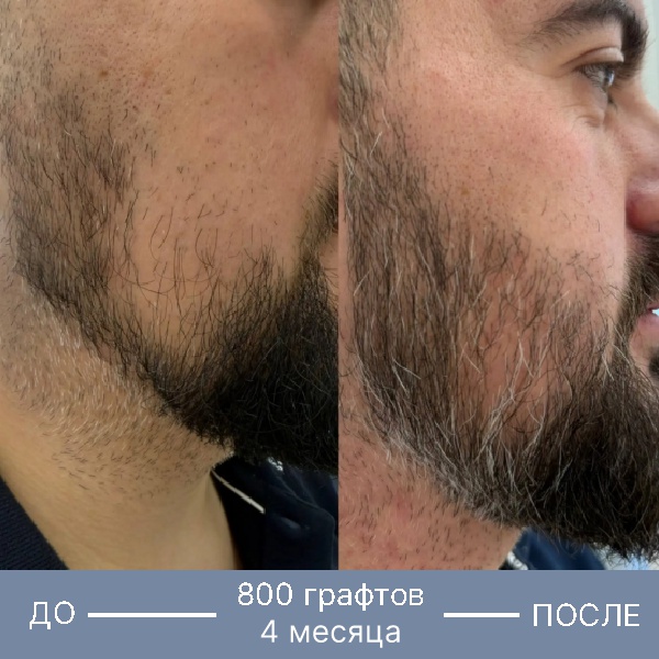 Результат пересадки бороды