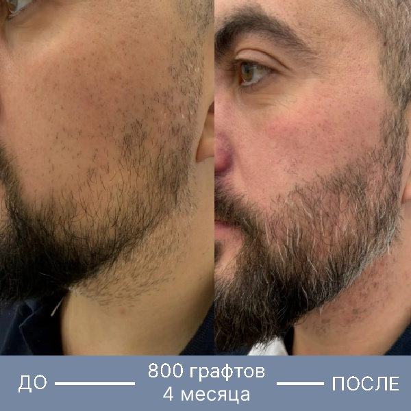 Результат пересадки бороды